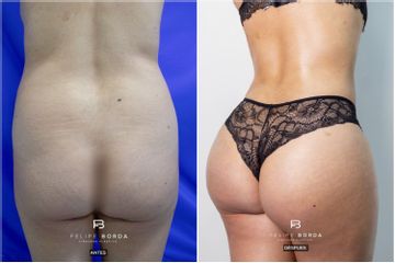 Gluteoplastia - Dr. Luis Felipe Borda