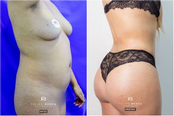 Liposucción - Dr. Luis Felipe Borda