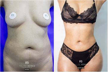 Liposucción - Dr. Luis Felipe Borda