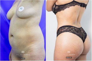 Liposucción - Dr. Luis Felipe Borda