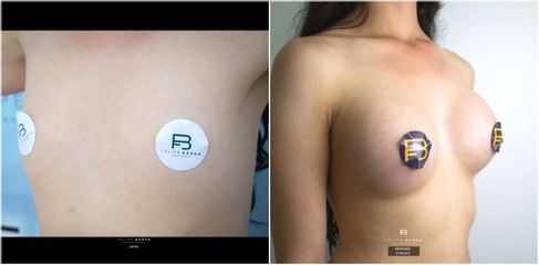 Mamoplastia de aumento - Dr. Luis Felipe Borda