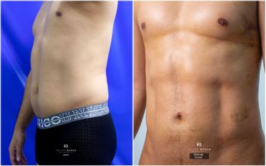 Liposucción - Dr. Luis Felipe Borda