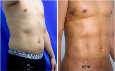 Liposucción - Dr. Luis Felipe Borda