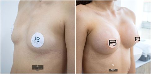 Mamoplastia de aumento - Dr. Luis Felipe Borda