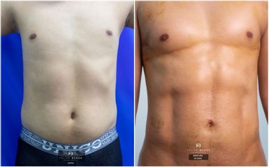 Liposucción - Dr. Luis Felipe Borda