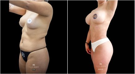 Abdominoplastia - Dr. Luis Felipe Borda