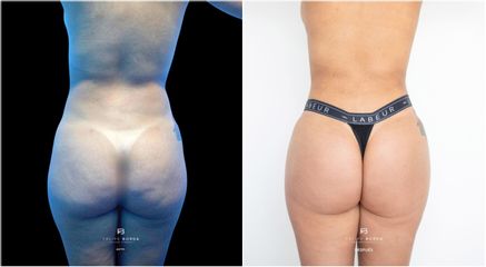 Liposucción - Dr. Luis Felipe Borda