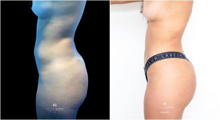 Liposucción - Dr. Luis Felipe Borda