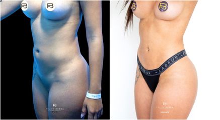 Liposucción - Dr. Luis Felipe Borda