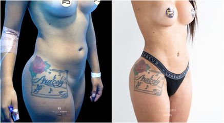 Liposucción - Dr. Luis Felipe Borda