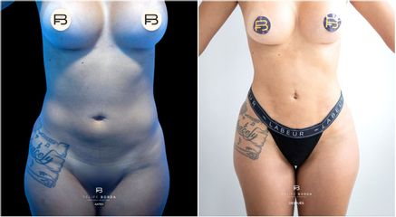 Liposucción - Dr. Luis Felipe Borda