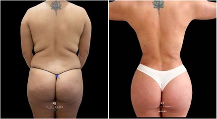 Abdominoplastia - Dr. Luis Felipe Borda