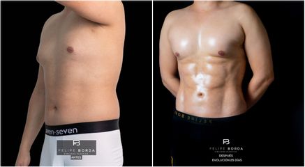 Marcación abdominal - Dr. Luis Felipe Borda