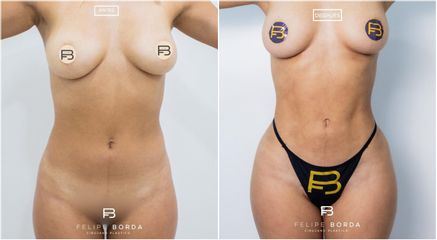 Liposucción - Dr. Luis Felipe Borda