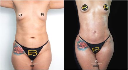 Liposucción - Dr. Luis Felipe Borda
