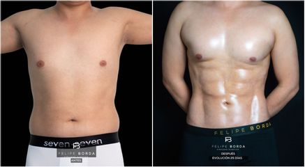 Liposucción - Dr. Luis Felipe Borda