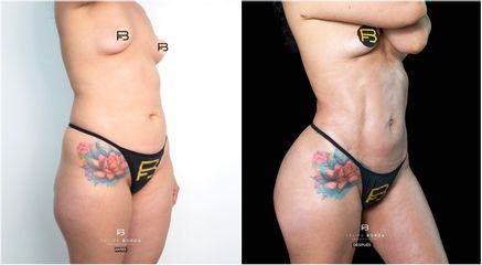 Liposucción - Dr. Luis Felipe Borda