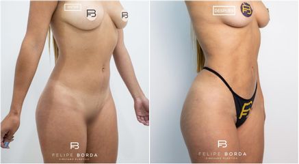 Liposucción - Dr. Luis Felipe Borda