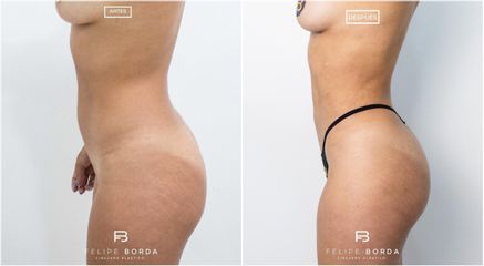 Liposucción - Dr. Luis Felipe Borda