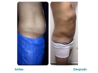 Abdominoplastia