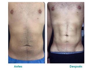 Marcación abdominal