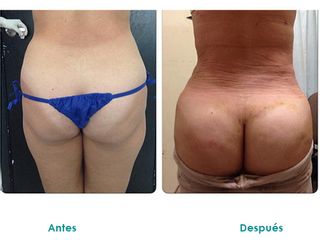 Aumento de glúteos