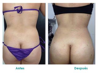 Aumento natural de glúteos