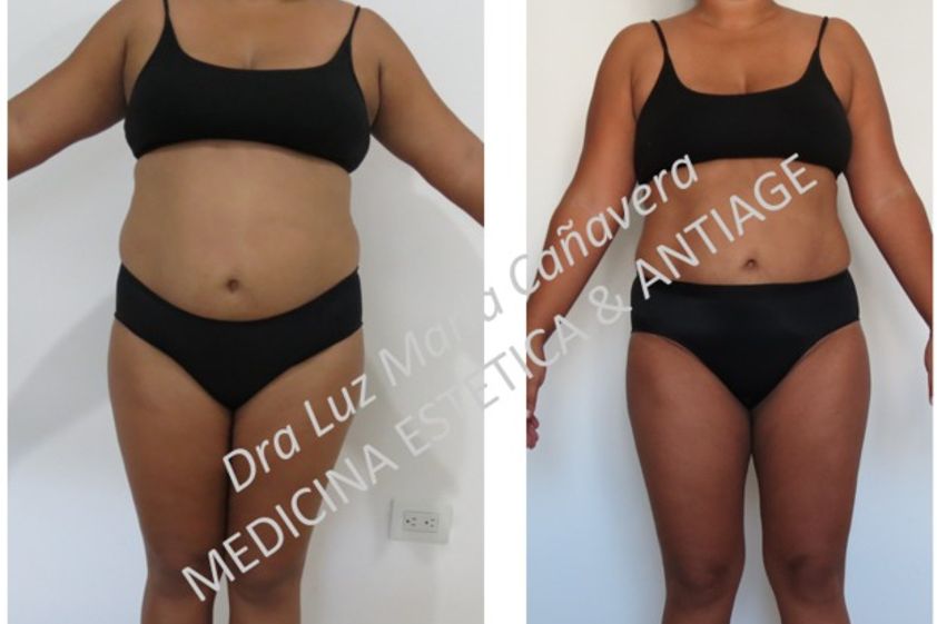 Tratamientos para adelgazar antes y después - 598622