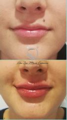 Aumento de labios - Luz Maria Cañavera