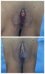 antes y despues Labioplastia - Dra. Luz Maria Cañavera