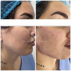 Rejuvenecimiento facial - Dra. Luz Maria Cañavera