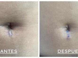 Cicatrices antes y después - 795018