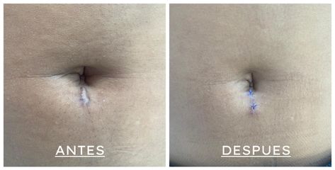 antes y después cicatrices - Dra. Luz Maria Cañavera