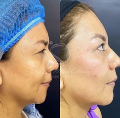 Rejuvenecimiento Facial - Dra. Luz María Cañavera