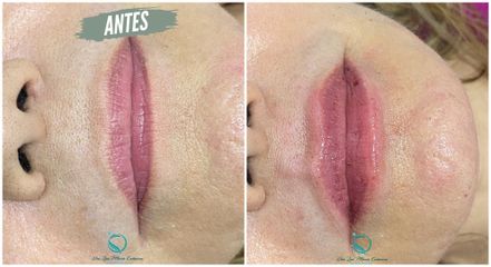 Aumento de labios - Dra. Luz María Cañavera