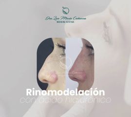 Rinomodelación  - Dra. Luz María Cañavera