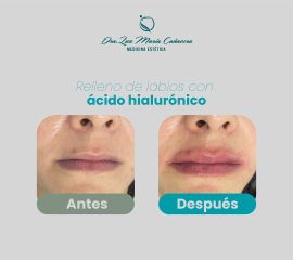 Aumento de labios - Dra. Luz María Cañavera