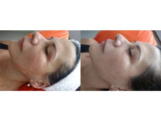 Rejuvenecimiento facial - Novastética