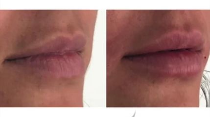 Aumento de labios - Novastética