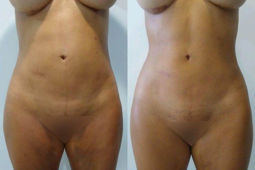 Mesoterapia antes y después - 785890