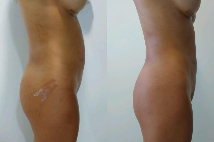Mesoterapia antes y después - 785891
