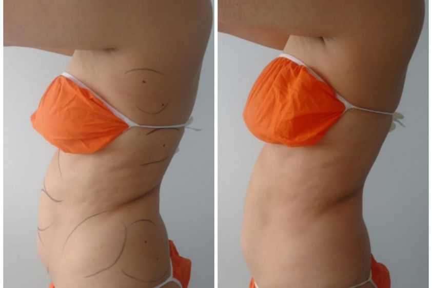 Mesoterapia antes y después - 785892