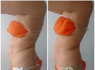 Mesoterapia - Novastética