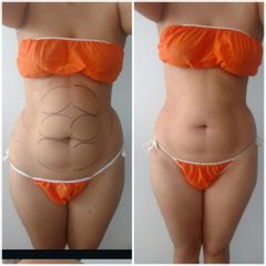 Mesoterapia - Novastética