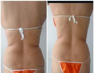 Mesoterapia - Novastética
