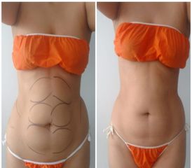 Mesoterapia - Novastética
