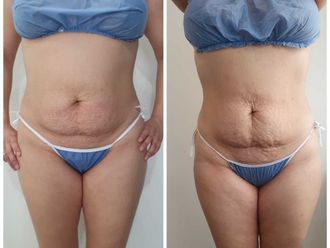 Mesoterapia antes y después - 793407