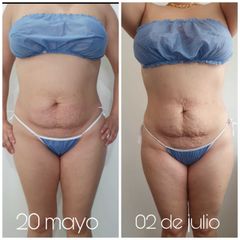 Mesoterapia - Novastética