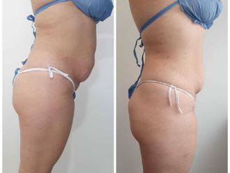 Mesoterapia antes y después - 793408