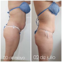 Mesoterapia - Novastética